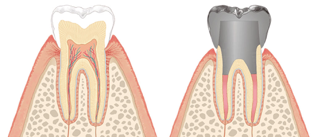 天然歯と人工歯