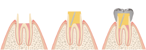 差し歯におけるプラスチックの土台を作る治療