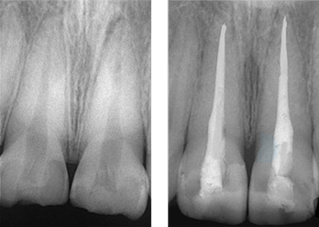 前歯部の根管充填の術前（左）と 術後（右）