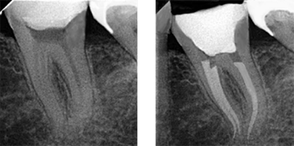 臼歯部の根管充填の術前（左）と 術後（右）