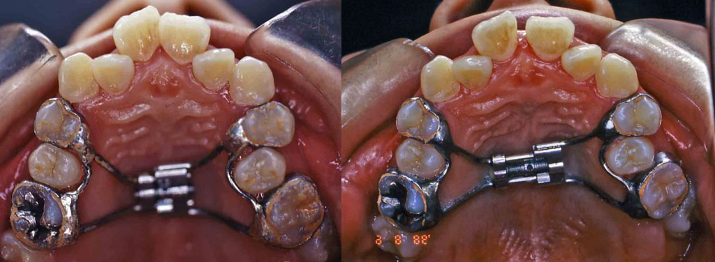 矯正歯科の基礎知識 vol.3 固定式装置って何がある？│歯科スタッフ 